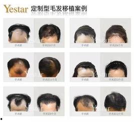 明星头发移植,揭秘头发移植的神奇魅力